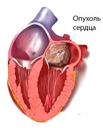 Опухоли сердца – разнородные по гистологическому строению новообразования, первично возникающие из тканей сердца или прорастающие в них из других органов. Опухоли сердца, в зависимости от их типа, локализации и размера, могут вызывать одышку, кашель, тахикардию, аритмии, боли за грудиной, сердечную недостаточность, тампонаду сердца, тромбоэмболии. Диагностика опухолей сердца проводится с учетом данных ЭхоКГ, рентгенографии, вентрикулографии, МРТ и МСКТ сердца, ЭКГ, биопсии. При выявлении первичных доброкачественных опухолей сердца производится их радикальное иссечение; лечение первичных злокачественных и метастатических новообразований обычно паллиативное (лучевая терапия, химиотерапия). 