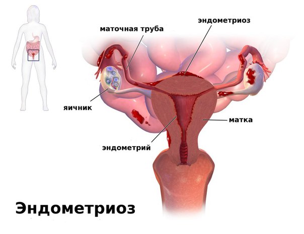 Эндометриоз - патологический процесс, характеризующийся ростом и развитием ткани, идентичной по структуре и функциям с эндометрием, за пределами границ нормальной локализации слизистой оболочки матки. 