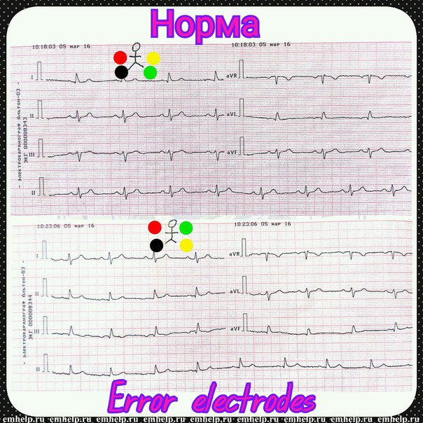 Нормальная ЭКГ и варианты ЭКГ при неправильном наложении электродов.