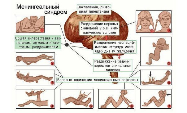 Менингеальные симптомы 