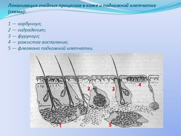 ГНОЙНЫЕ ВОСПАЛЕНИЯ КОЖИ И ПОДКОЖНОЙ КЛЕТЧАТКИ