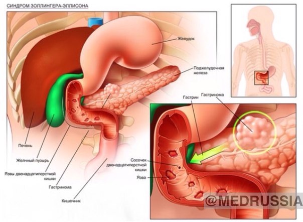 Синдром золлингера эллисона картинки