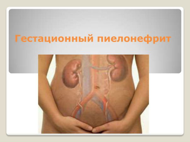 Пиелонефрит и беременность 