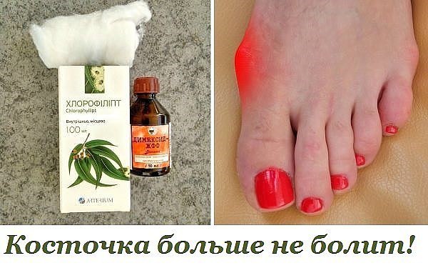 Косточка больше не болит! Потратила мелкие деньги на 2 средства, эффект невероятен. 