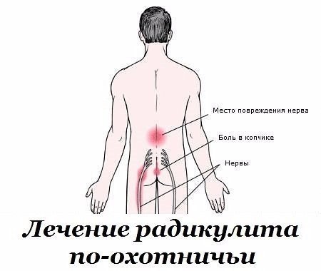 Лечение радикулита по-охотничьи. Старинный рецепт 
