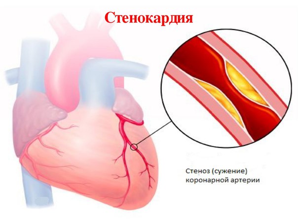 Ишемическая болезнь сердца — это группа заболеваний, которые характеризуются нарушением кровообращения в артериях, призванных обеспечивать сердечную мышцу (миокард) необходимым запасом крови. Из-за того, что эти артерии называются коронарными, то и ишемия (недостаточное кровоснабжение органа) получила название 