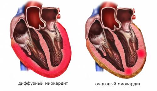 Миокардит — это воспаление мышечной оболочки сердца (миокарда), проявляющееся нарушением ее функции — созданием ритмических движений сердца. 