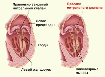Пролапс митрального клапана — это ненормальное прогибание (выбухание) одной или двух створок митрального клапана (клапана между левым предсердием и желудочком) во время сокращения левого желудочка. Это заболевание встречается в любом возрасте как у мужчин, так и у женщин. 