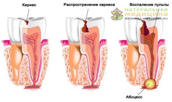 Профилaктикa кaриесa – кaк остaновить и предотврaтить кaриес зубов