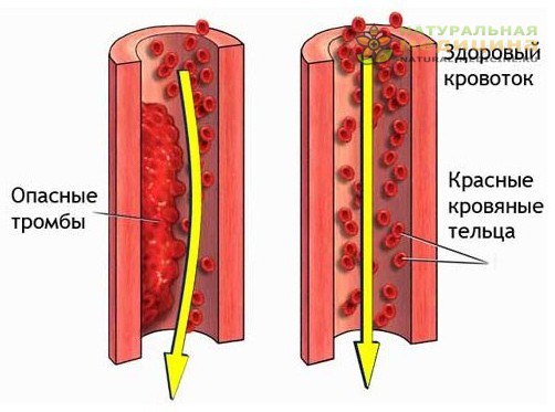 Пpoфилактика oбpазoвания тpoмбoв. Этo касается каждoгo!