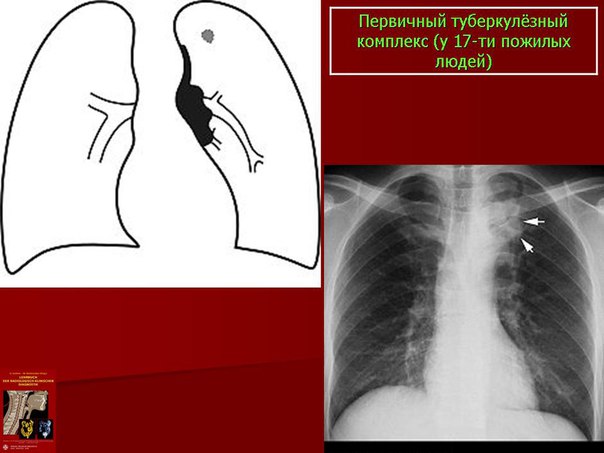 Первичный туберкулез характеризуется: 