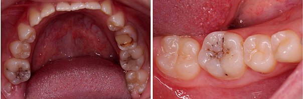 #статьи_alldental #реставрация_alldental #силиконовый_ключ