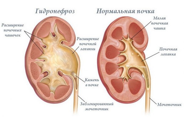 Гидронефроз развивается в результате нарушения оттока мочи и характеризуется расширением лоханочно-чашечной системы, патологическими изменениями интерстициальной ткани почки и атрофией ее паренхимы. Гидронефроз правой или левой почки встречается одинаково часто, двухсторонний - лишь в 5-9 % случаев этого заболевания. 