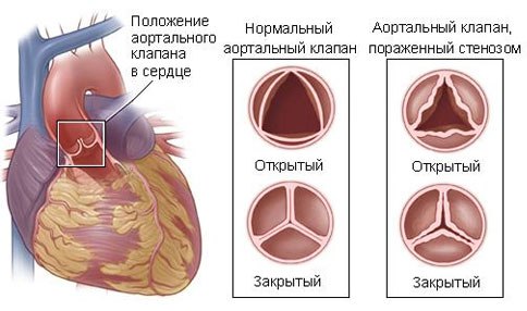 Стеноз устья аорты - сужение выносящего тракта левого желудочка в области аортального клапана. 