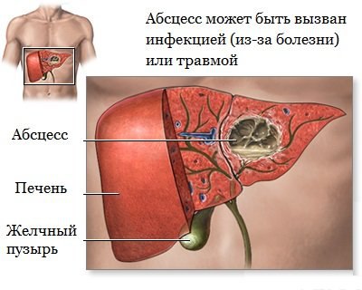 Абсцесс печени 