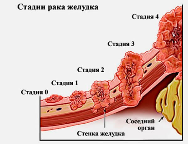 Рак желудка 