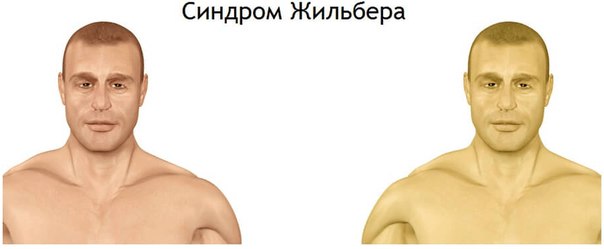 Синдром Жильбера – генетически обусловленное нарушение обмена билирубина, возникающее вследствие дефекта микросомальных ферментов печени и приводящее к развитию доброкачественной неконьюгированной гипербилирубинемии. В большинстве случаев синдрома Жильбера отмечается интермиттирующая желтуха различной степени выраженности, тяжесть в правом подреберье, диспепсические и астеновегетативные расстройства; возможно появление субфебрилитета, гепатомегалии, ксантелазм век. Диагноз синдрома Жильбера подтверждают данные клинической картины, семейного анамнеза, лабораторных и инструментальных исследований, функциональных проб. При синдроме Жильбера показано соблюдение режима питания, прием индукторов микросомальных ферментов, гепатопротекторов, желчегонных трав, энтеросорбентов, витаминов. 
