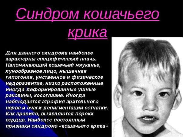 Синдром кошачьего крика 