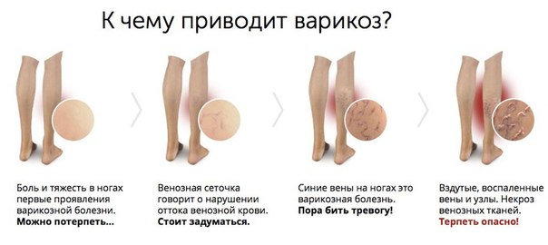 Самомассаж для профилактики варикозного расширения вен. 
