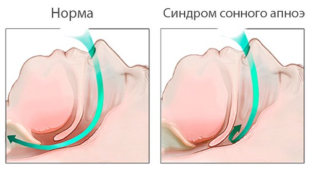 Апноэ - задержки дыхания во время сна более чем на 10 с, нередко сменяющиеся повторными эпизодами взрывного храпа, чрезмерной двигательной активностью, иногда пробуждением. Гипопноэ - эпизоды ослабленного дыхания во сне, при этом происходит соответственно прекращение или задержка воздушного потока через дыхательные пути по меньшей мере на 50%. В результате недостаточность ночного сна и сонливость днем. Отмечаются частые жалобы на утреннюю диффузную головную боль, гипнагогические галлюцинации, снижение либидо, склонность к апатии, признаки астенического или астенонев- ротического синдрома. Во время эпизодов апноэ и гипопноэ снижается на- сыщенность крови кислородом, в некоторых случаях возникает брадикардия, сменяющаяся тахикардией. 