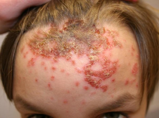 Стрептодермия