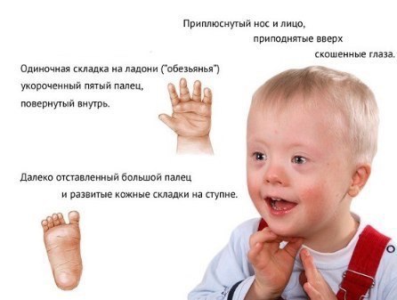 СИНДРОМ ДАУНА