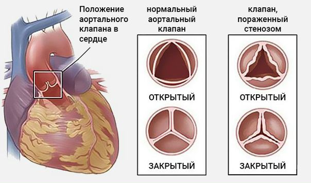 Аортальный стеноз - стеноз устья аорты. Пока аортальный стеноз компенсирован, беременность не противопоказана. Однако даже начальные признаки недостаточности кровообращения служат противопоказанием к ней. Чаще женщины умирают не в гестационный период, а через год после родов. 
