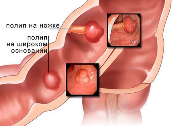 Полипы желудка