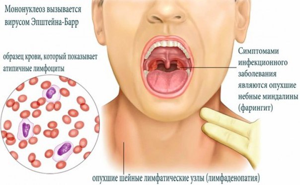 Инфекционный мононуклеоз — острое вирусное заболевание, которое характеризуется лихорадкой, поражением зева, лимфатических узлов, печени, селезёнки и своеобразными изменениями состава крови. 