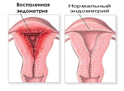 Эндометрит – воспаление слизистой оболочки матки (эндометрия). Острый воспалительный процесс может вызываться бактериальной, вирусной, грибковой, паразитарной, микоплазменной, протозойной и спирохетозной инфекцией. Чаще всего вызывается смешанной аэробно-анаэробной ассоциацией нескольких микроорганизмов. Чаще всего в воспалительный процесс вовлекается и мышечная оболочка матки с развитием миоэндометрита. 