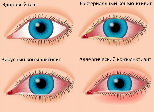 Классификация конъюнктивитов 