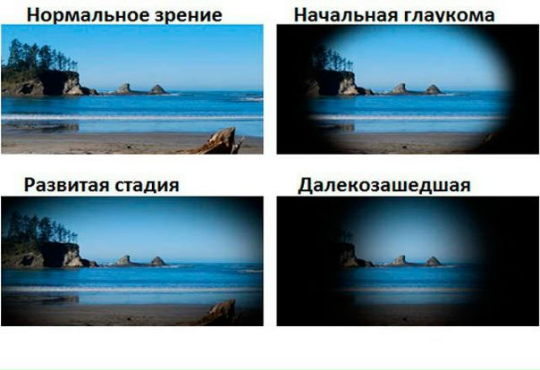 Стадии глаукомы 