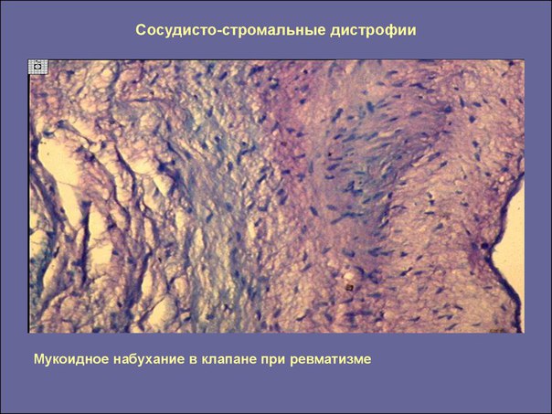 Стромально-сосудистая дистрофия 