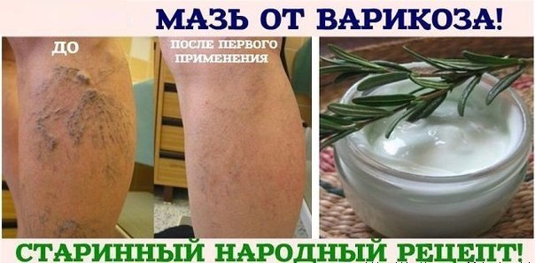 Мазь от варикозного! 
