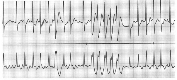 ЛЕКЦИЯ ОБ АРИТМИИ