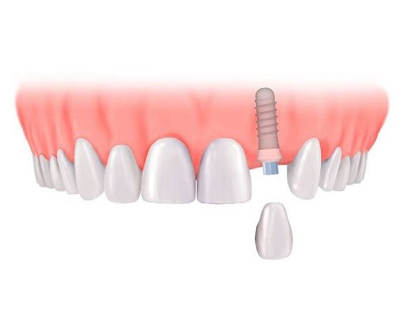 Ученые сконструировали зубной протез, предотвращающий воспаление десен