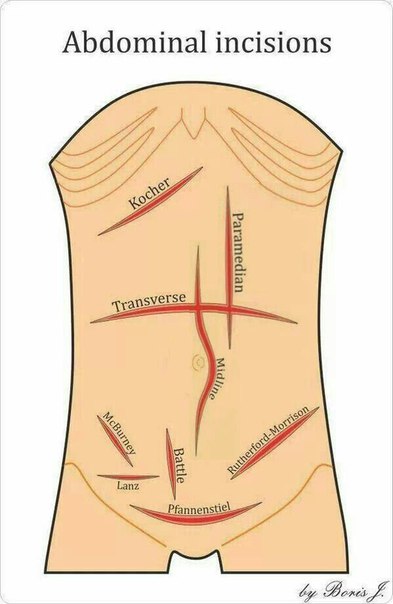 Доступ по Кохеру - доступ к желчным путям и печеночному углу толстой кишки- косой разрез в правом подреберье параллельно реберной дуге и ниже ее на 2-3 см. 