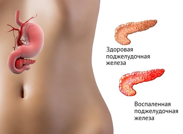 «Алкогольный» панкреатит. 