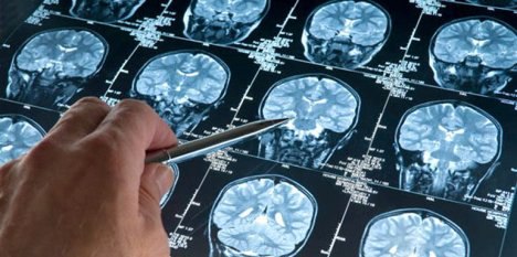 Неврологи научились выявлять скрытые сотрясения мозга