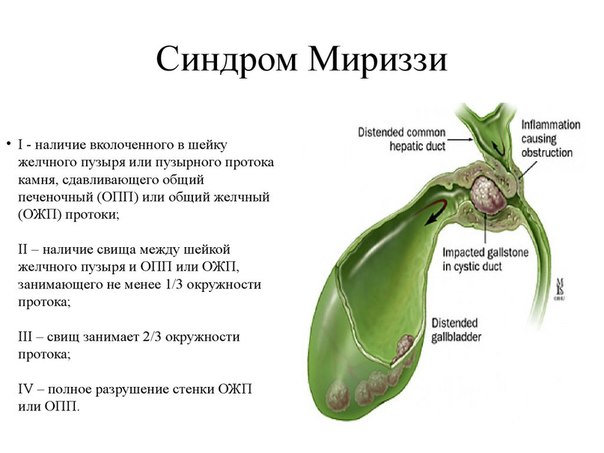 Синдром Миризи – это осложнение желчнокаменной болезни в виде частичного сужения общего печеночного протока в результате воспаления в нем и сдавления извне желчным конкрементом, расположенным в пузырном протоке или шейке желчного пузыря, что в дальнейшем приводит к образованию стриктуры общего печеночного протока (проксимального отдела гепатикохоледоха) или к образованию холецисто-холедохеального свища. 