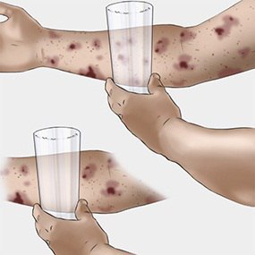 Как не заболеть менингитом 