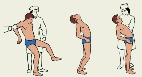 Мозжечковая атаксия - обобщённый термин, указывающий на нарушение координации движений при повреждениях, заболеваниях мозжечка и его связей. Проявляется специфическими нарушениями походки (дисбазия мозжечковая), равновесия, дискоординации движений, нарушением плавности речи (мозжечковая дизартрия), различными видами мозжечкового тремора, гипотонией мышц, окуломоторной дисфункцией и, иногда, головокружением. В силу множества различного типа поражений мозжечка, клинического разнообразия описываемой симптоматики, единой классификации мозжечковой атаксии не создано по сей день. Для практикующего невролога удобна классификация, основанная на клинических признаках и особенностях течения атаксии, в значительной степени облегчающая диагностический поиск. 