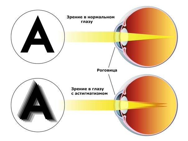  АСТИГМАТИЗМ