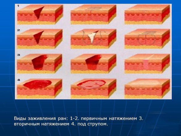 Виды заживления ран 