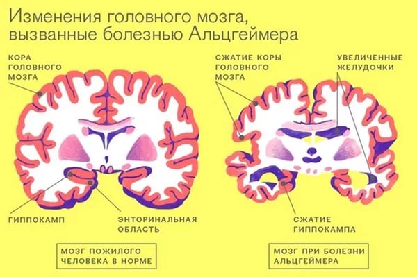 Болезнь Альцгеймера — прогрессирующая форма сенильной деменции, приводящая к полной утрате когнитивных способностей, развивающаяся преимущественно после 60-65 лет. Клинически проявляется возникающим исподволь и постоянно прогрессирующим расстройством когнитивных способностей: внимания, памяти, речи, праксиса, гнозиса, психомоторной координации, ориентации и мышления. Диагностировать болезнь Альцгеймера позволяет тщательный сбор анамнеза, ПЭТ головного мозга, исключение других типов деменции при помощи ЭЭГ, КТ или МРТ. Лечение является паллиативным, включает медикаментозную (ингибиторы холинэстеразы, мемантин) и психосоциальную (арт-терапия, психотерапия, сенсорная интеграция, симуляция присутствия) терапию. 