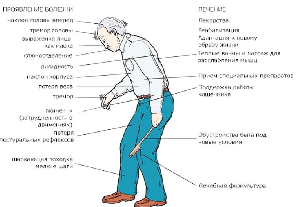 Болезнь Паркинсона — медленно прогрессирующее дегенеративное заболевание центральной нервной системы, основными проявлениями которого являются такие двигательные нарушения, как гипокинезия, ригидность мышц, тремор покоя, постуральные расстройства. Кроме этого при болезни Паркинсона развиваются вегетативные, аффективные и другие расстройства.Различают истинный паркинсонизм(болезнь Паркинсона) и синдром паркинсонизма, который может сопровождать многие неврологические заболевания (ЧМТ, опухоли головного мозга, инсульты, энцефалиты и пр.). При подозрении на болензнь Паркинсона пациенту необходимо пройти электроэнцефалографию, реоэнцефалографию, МРТ головного мозга. 