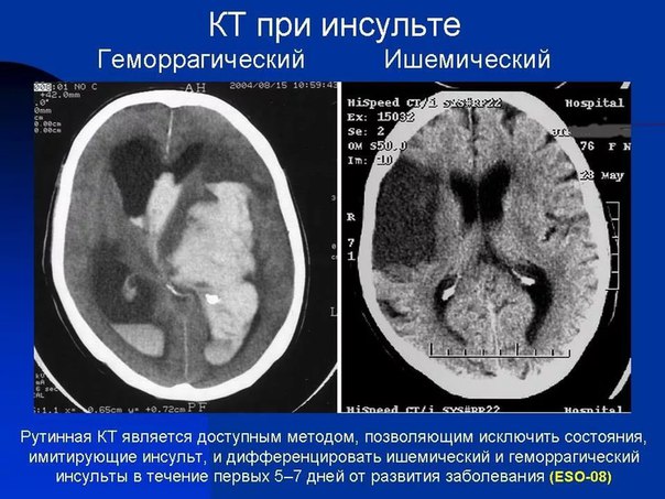 Геморрагический инсульт — спонтанное (нетравматическое) кровоизлияние в полость черепа. Термин «геморрагический инсульт» используют, как правило, для обозначения внутримозгового кровоизлияния, произошедшего в результате какого-либо сосудистого заболевания головного мозга: атеросклероза, гипертонической болезни и амилоидной ангиопатии. Наиболее часто геморрагический инсульт возникает на фоне повышенного артериального давления. Клиническая картина характеризуется острым началом и быстрым развитием симптомов, которые напрямую зависят от локализации сосудистой катастрофы. Геморрагический инсульт требует неотложной гемостатической, антигипертензионной и противоотечной терапии. По показаниям проводится хирургическое лечение. 