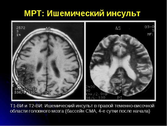 Ишемический инсульт — патологическое состояние, представляющее собой не отдельное или самостоятельное заболевание, а эпизод, развивающийся в рамках прогрессирующего общего или локального сосудистого поражения при различных заболеваниях сердечно-сосудистой системы. Зачастую ишемический инсульт сопутствует следующим заболеваниям: артериальная гипертензия, атеросклероз, ревматический порок сердца, ишемическая болезнь сердца, сахарный диабет и иные формы патологии с поражением сосудов. Клиника ишемического инсульта состоит из общемозговых и очаговых симптомов, зависящих от локализации сосудистых нарушений. Важнейший метод инструментальной диагностики ишемического инсульта, а также его дифференцировки от геморрагического инсульта, - это КТ и МРТ головного мозга. 