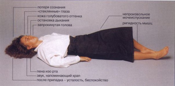Эпилепсия — состояние, характеризующееся повторными (более двух) эпилептическими приступами, не спровоцированными какими-либо немедленно определяемыми причинами. Эпилептический приступ — клиническое проявление аномального и избыточного разряда нейронов мозга, вызывающего внезапные транзиторные патологические феномены (чувствительные, двигательные, психические, вегетативные симптомы, изменения сознания). Следует помнить, что несколько спровоцированных или обусловленных какими-либо отчетливыми причинами (опухоль мозга, ЧМТ) эпилептических приступов не свидетельствуют о наличии у пациента эпилепсии. 
