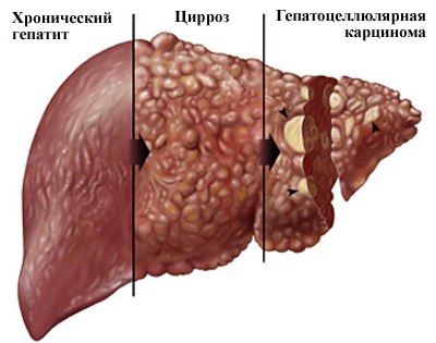 Хронический гепатит - это диффузное воспалительно-дистрофическое заболевание печени, возникающее по различным причинам, оно длится свыше 6 месяцев. 